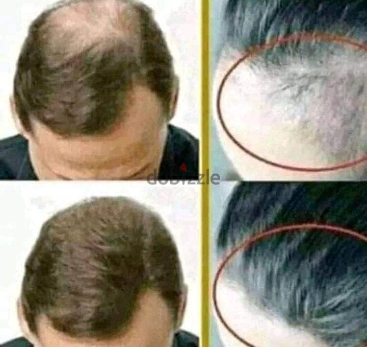 Hair loss challenge 0