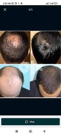 Hair loss solution ™ 0